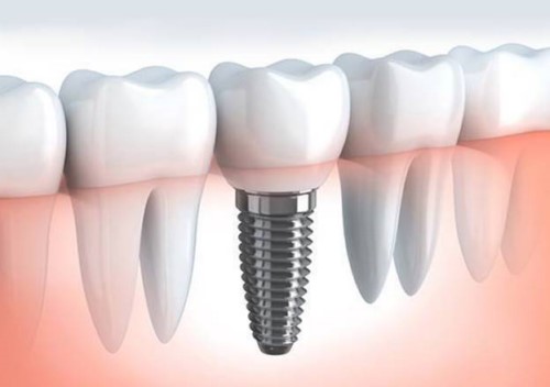 răng sứ trên implant có thay mới được không