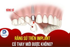 răng sứ trên implant có thay mới được không