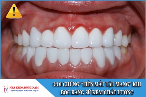 Coi chừng "Tiền mất tật mang" khi bọc răng sứ kém chất lượng
