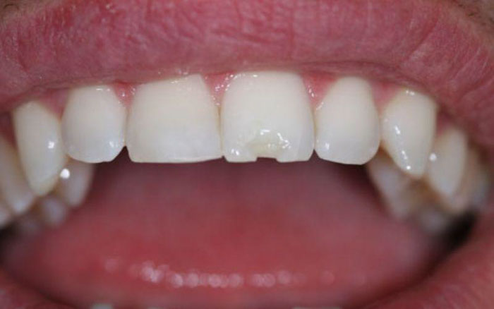 Vật liệu sứ không đảm bảo dễ khiến răng sứ bị nứt vỡ
