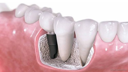 vì sao trồng răng implant lại có chi phí cao