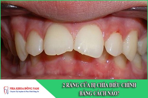 2 Răng cửa bị chìa điều chỉnh bằng cách nào