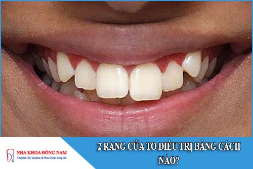 2 răng cửa to điều trị bằng cách nào