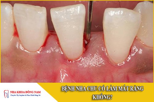 Bệnh nha chu có làm mất răng không