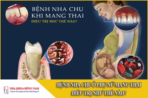 bệnh nha chu ở phụ nữ mang thai