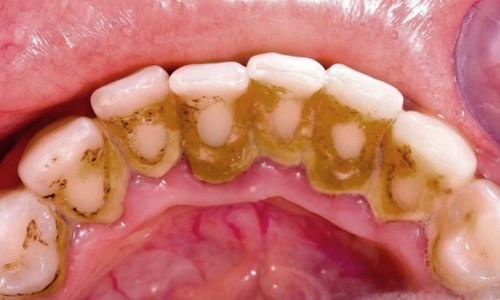 vôi răng gây viêm nướu
