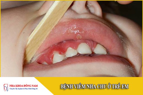 Bệnh viêm nha chu ở trẻ em