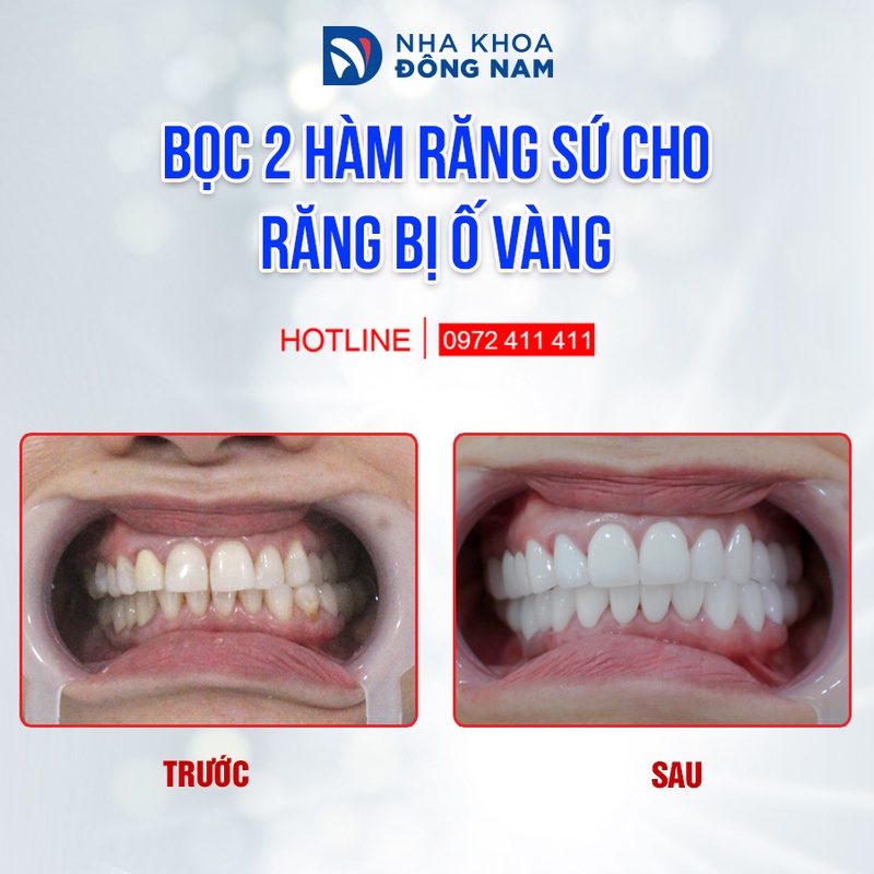 Bọc 4 răng sứ cho răng mọc lộn xộn và ố vàng tại Nha Khoa Đông Nam