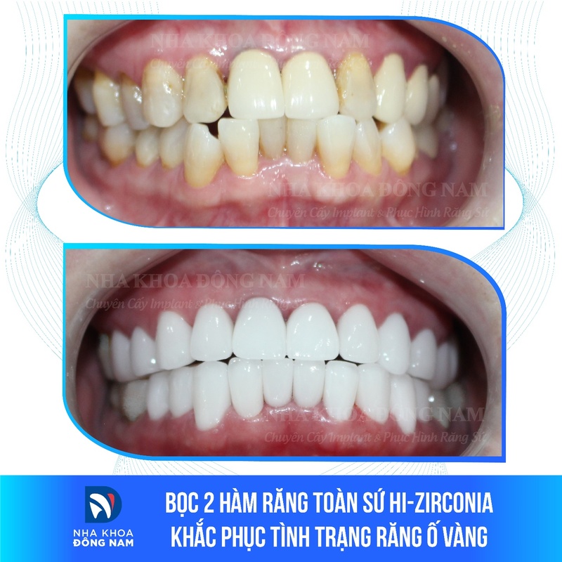 Bọc răng sứ cho trường hợp răng ố vàng, mọc không đều
