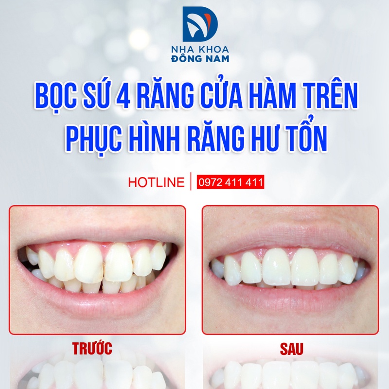 Bọc sứ 4 răng cửa phục hình răng hư tổn
