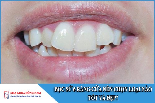 Bọc sứ 6 răng cửa nên chọn loại nào tốt và đẹp