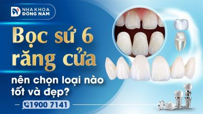 Bọc sứ 6 răng cửa nên chọn loại nào tốt và đẹp?