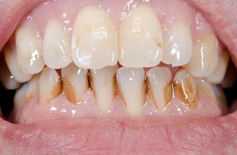 Bọc sứ cho răng xỉn màu ố vàng