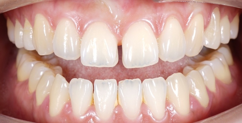 Bọc sứ cho trường hợp răng cửa thưa