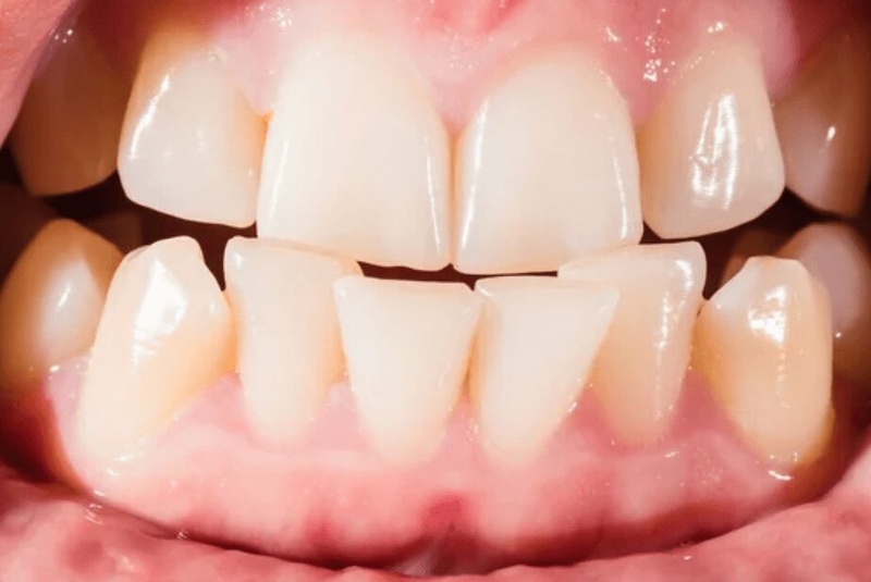 Bọc sứ cho trường hợp răng lệch lạc nhẹ