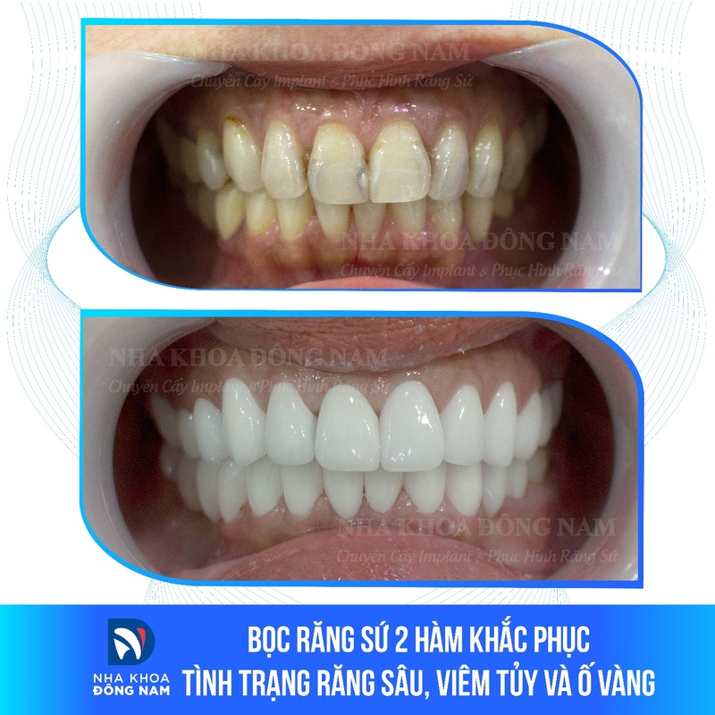 Bọc sứ toàn sứ 2 hàm cho răng bị viêm tủy, ố vàng