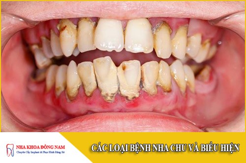 Các loại bệnh nha chu và biểu hiện
