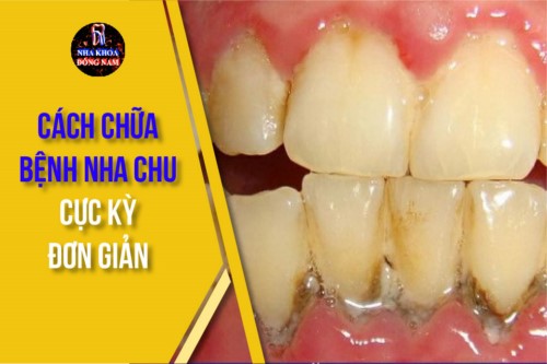 Cách chữa bệnh nha chu đơn giản