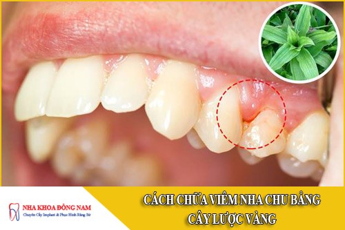 cách chữa viêm nha chu bằng cây lược vàng
