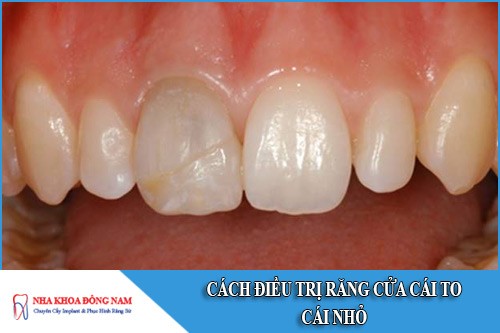 cách điều trị răng cửa cái to cái nhỏ
