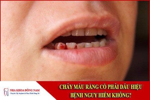 Chảy máu răng có phải dấu hiệu bệnh nguy hiểm không