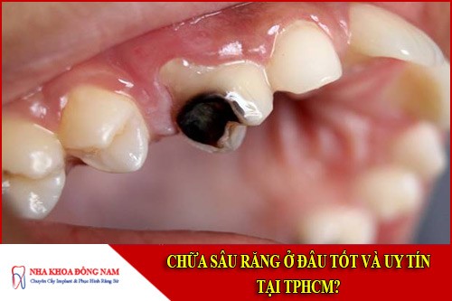 chữa sâu răng ở đâu tốt nhất tphcm