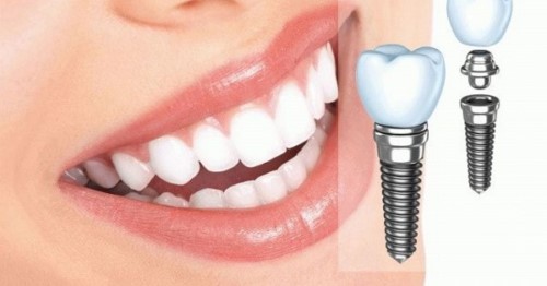 trồng răng implant