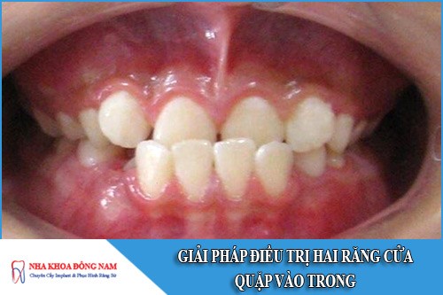 giải pháp điều trị hai răng cửa quặp vào trong