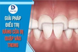 giải pháp điều trị hai răng cửa quặp vào trong