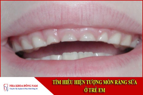 Tìm hiểu hiện tượng mòn răng sữa ở trẻ em
