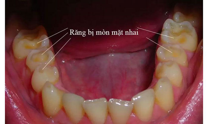 Hình ảnh răng bị mòn mặt nhai