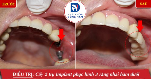 cấy 2 trụ implant răng nhai hàm trên