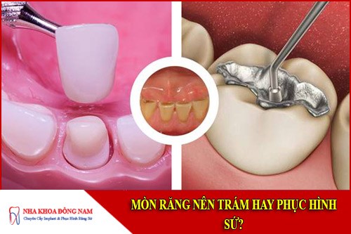 Mòn răng nên trám hay phục hình sứ