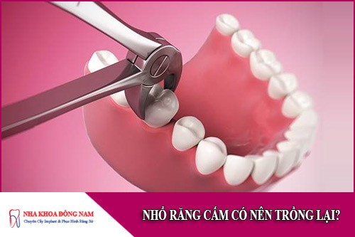 nhổ răng cấm có nên trồng lại