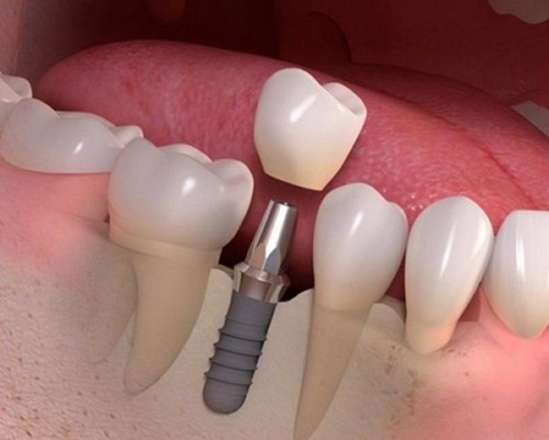 trồng răng cấm bằng implant