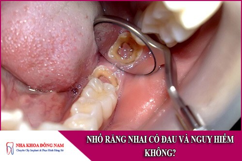 nhổ răng nhai có đau và nguy hiểm không