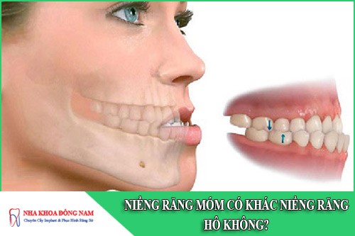 Niềng răng móm có khác niềng răng hô không bác sĩ