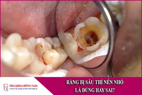 răng bị sâu thì nên nhổ là đúng hay sai