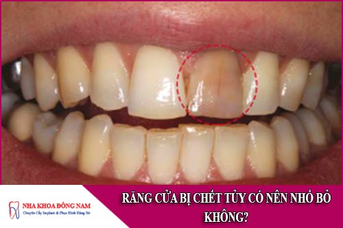 Răng cửa bị chết tủy có nên nhổ bỏ không
