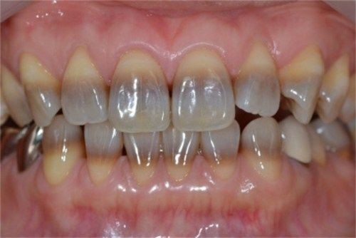 răng bị nhiễm màu