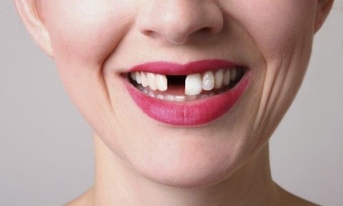 răng cửa bị gãy trồng lại bao nhiêu tiền