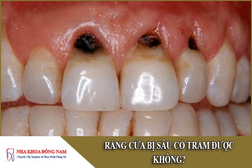 răng cửa bị sâu có trám được không