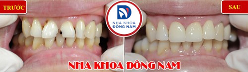 bọc răng sứ cho răng cửa bị sâu