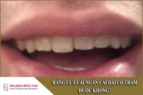 Răng cửa cái ngắn cái dài có trám được không