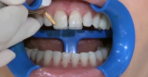 mô phỏng kỹ thuật trám răng