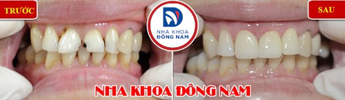 bọc sứ răng cửa bị hư tổn