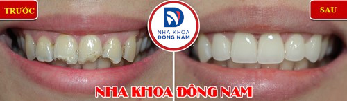 bọc sứ cho răng cửa mẻ