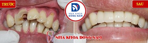 bọc sứ cho răng cửa bị sâu