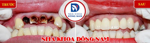 bọc sứ làm cùi giả cho răng cửa bị gãy