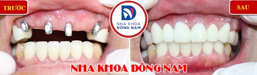 trồng răng implant cho răng cửa